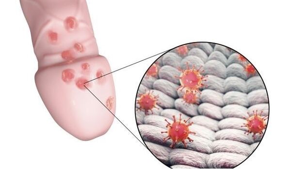 alergi kana gél enlargement sirit