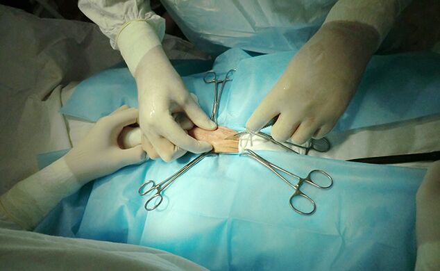 Bedah dina organ réproduktif bakal ngabantosan ningkatkeun ukuranana